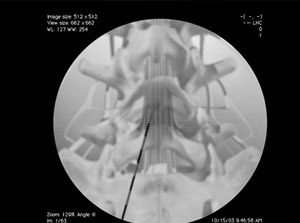 Epidural-steroid-injection-lumbar