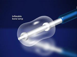 kyphoplasty